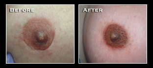 Artistry Of Permanent Makeup - Before & After Gallery - Hairline Enhancement