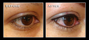 Artistry Of Permanent Makeup - Before & After Gallery - Permanent Eyeliner