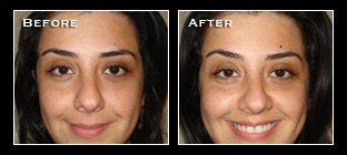 Artistry Of Permanent Makeup - Before & After Gallery - Permanent Eyebrows