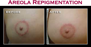 Artistry Of Permanent Makeup - Before & After Gallery - Areola Repigmentation