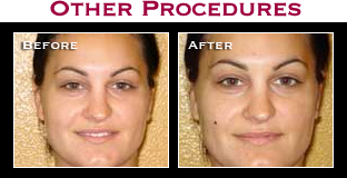 Artistry Of Permanent Makeup - Before & After Gallery - Beauty Marks & Other Procedures